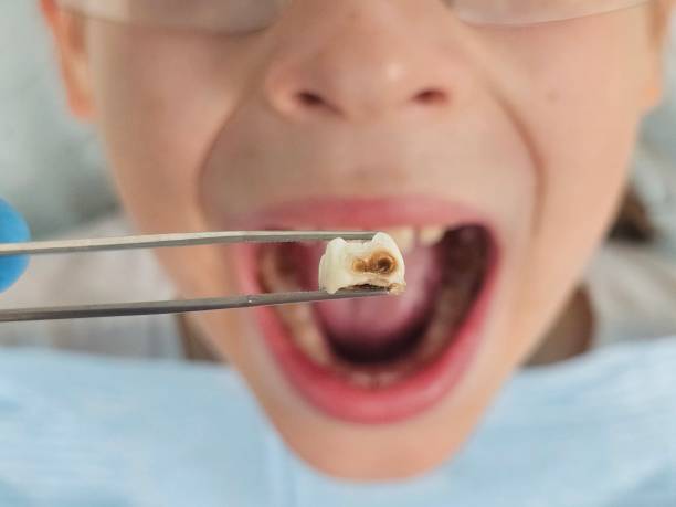 Best Emergency Treatment for Oral Infections in Fritch, TX